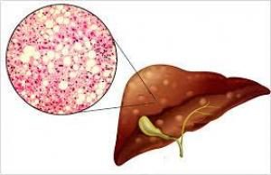 Даже легкая жировая болезнь печени связана с высоким риском смерти НАУКА